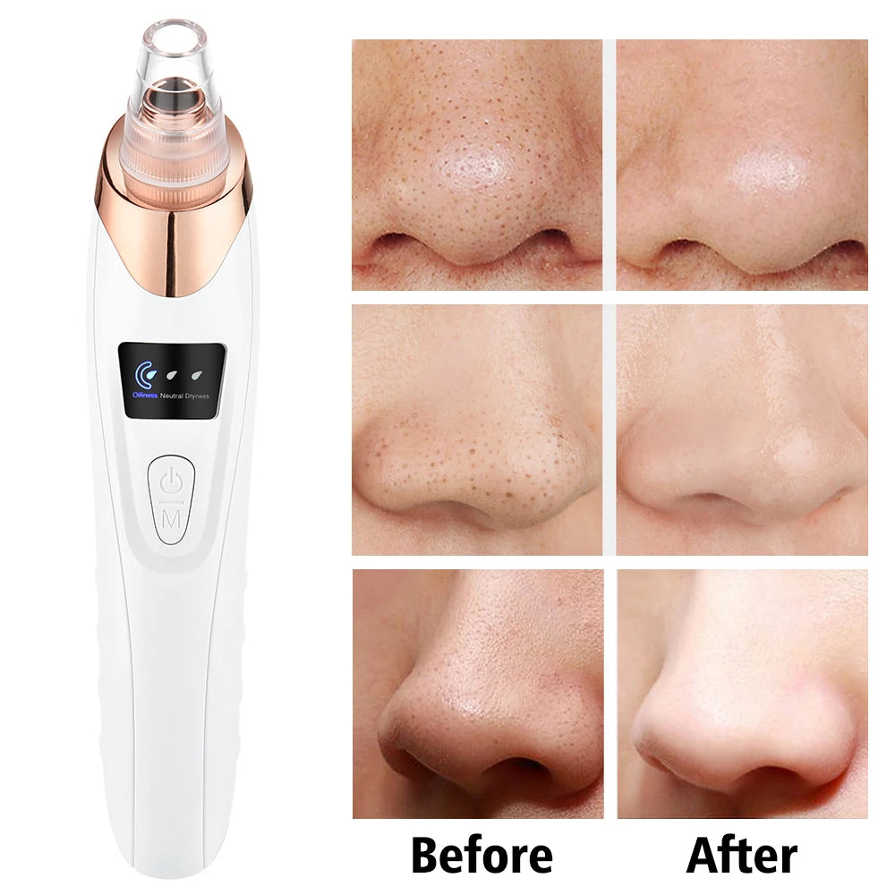 Electric Vacuum Blackhead Remover